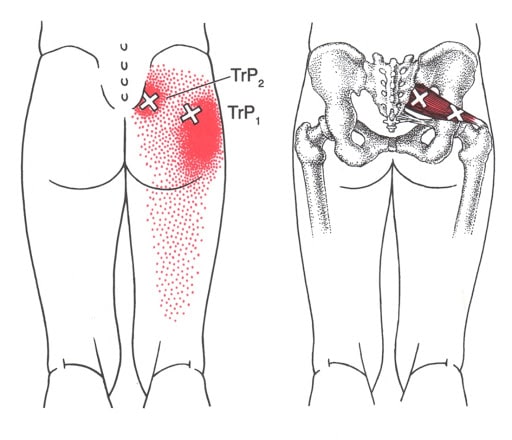 Piriformis-Trigger-Points